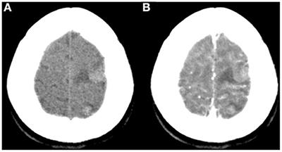 Case report: Multiple brain metastases of atrial myxoma: Clinical experience and literature review